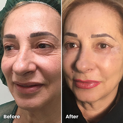 DermaVision™ + FREE SERUM