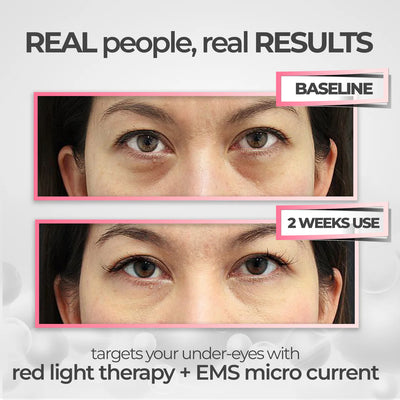 DermaVision™ Under-Eye Red Light Therapy