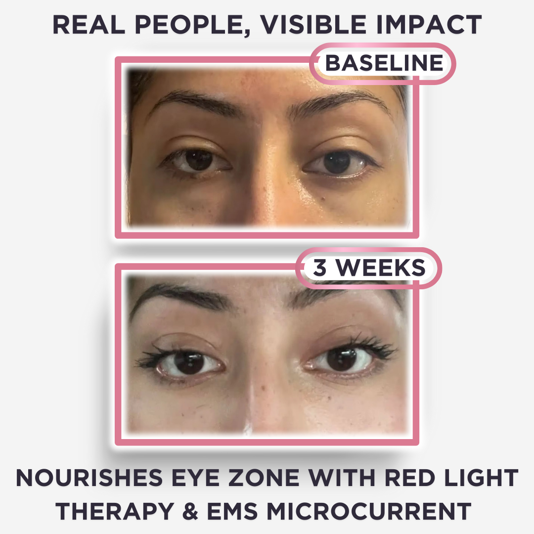 DermaVision™ Under-Eye Red Light Therapy